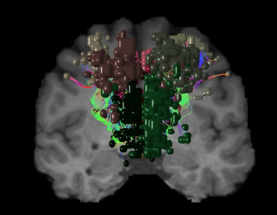 The Default Mode Network Dmn 5577